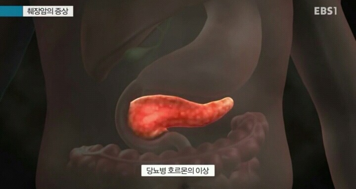 췌장암이 최악의 암으로 불리는 이유.jpg | 인스티즈