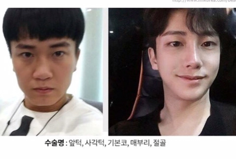 남자 성형 레전드 | 인스티즈