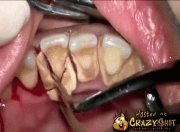 치아에 가득 쌓인 치석 제거하기 | 인스티즈